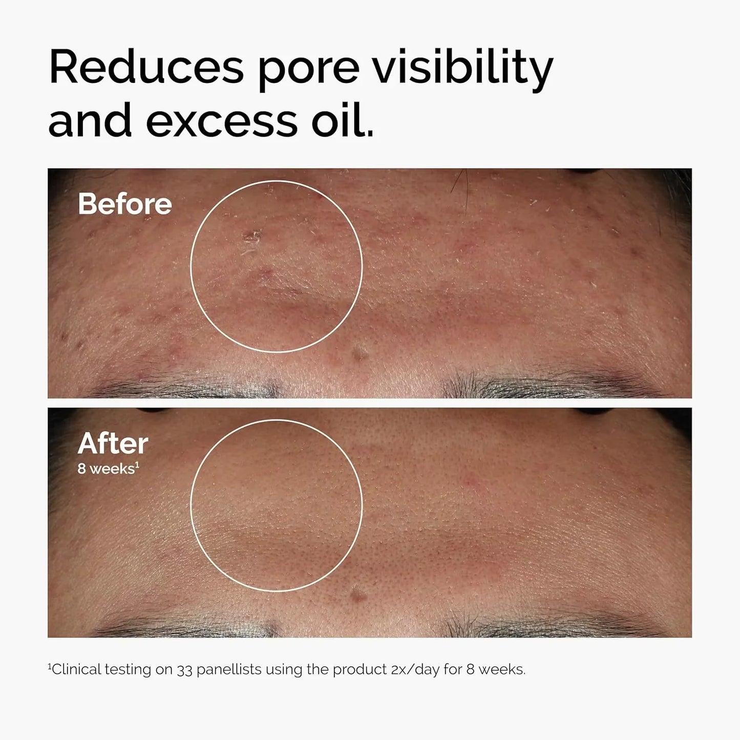 10% Niacinamide 1% Zinc Face Serum 30ml, Oil Control Pore Minimizer, Anti-Acne Dark Spot, Gentle Skin Care for All Skin Types