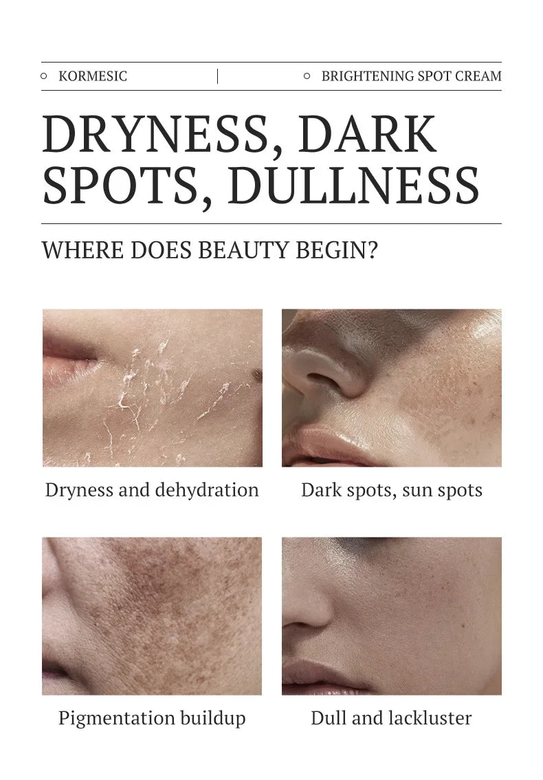 Dark Spots Removal Cream Facial Whitening Freckle Acne Mark Pigmentation Removal Melanin Skin Correction Brighten Care Products