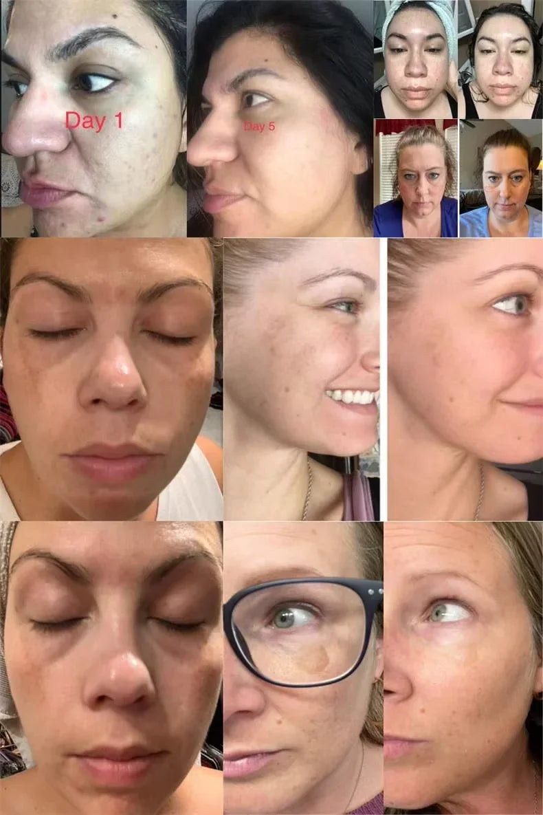 Dark Spots Removal Cream Facial Whitening Freckle Acne Mark Pigmentation Removal Melanin Skin Correction Brighten Care Products