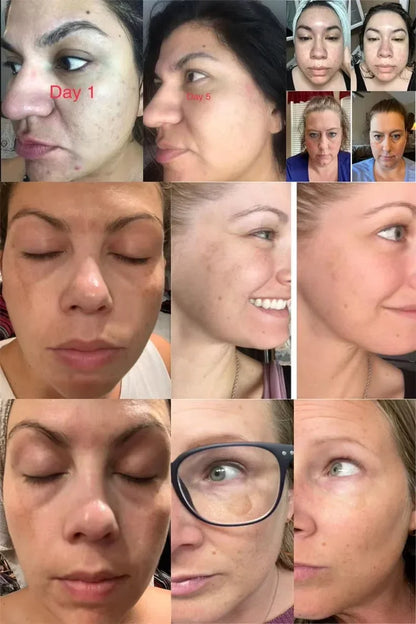 Dark Spots Removal Cream Facial Whitening Freckle Acne Mark Pigmentation Removal Melanin Skin Correction Brighten Care Products
