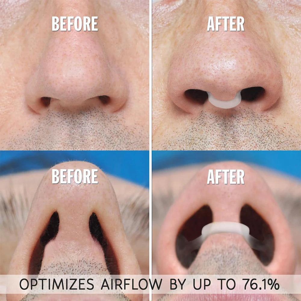 Silicone Nose Breathing Dilator, Nasal Clip for Snoring and Rhinitis, Easy Breathing Aid for Sleep Apnea