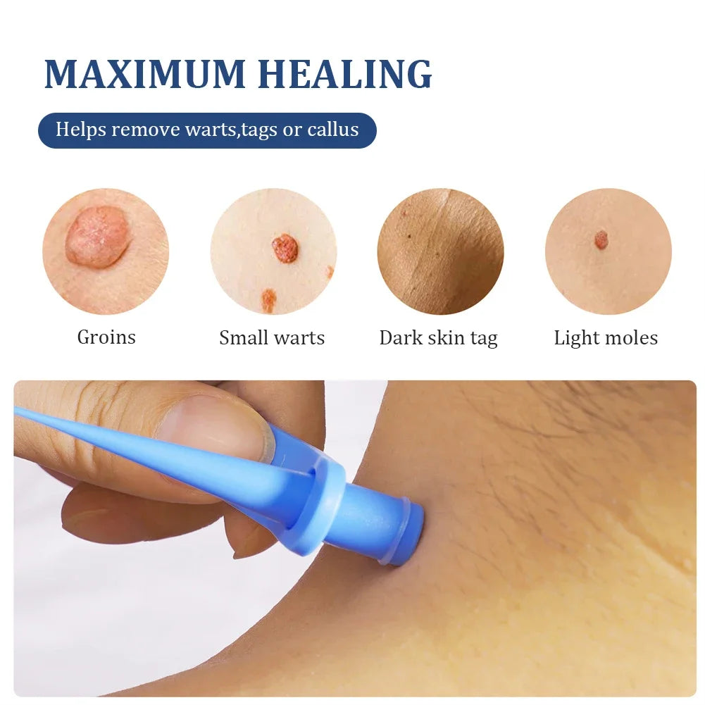2 In 1 Auto Skin Tag Removal Kit Painless Mole Wart Remover Equipment Micro 1-9mm Treatment Tool Easy To Clean Skin Care Tool