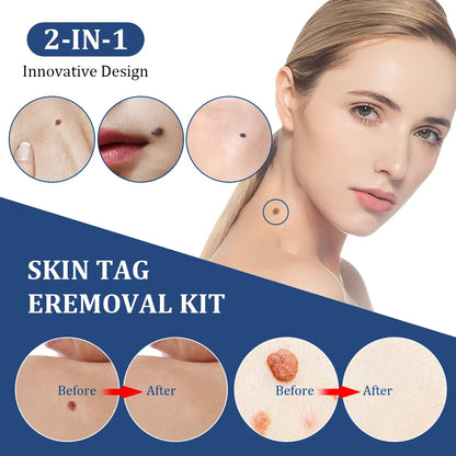 2 In 1 Auto Skin Tag Removal Kit Painless Mole Wart Remover Equipment Micro 1-9mm Treatment Tool Easy To Clean Skin Care Tool