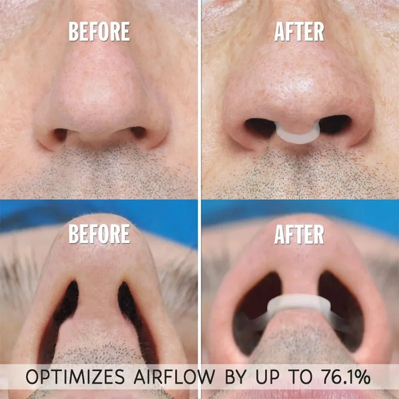 Silicone Nose Breathing Dilator, Nasal Clip for Snoring and Rhinitis, Easy Breathing Aid for Sleep Apnea