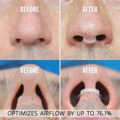 Silicone Nose Breathing Dilator, Nasal Clip for Snoring and Rhinitis, Easy Breathing Aid for Sleep Apnea