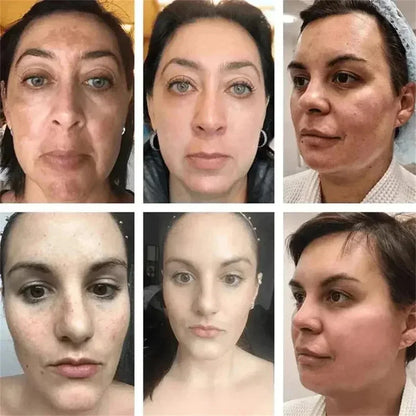 Dark Spots Removal Cream Facial Whitening Freckle Acne Mark Pigmentation Removal Melanin Skin Correction Brighten Care Products