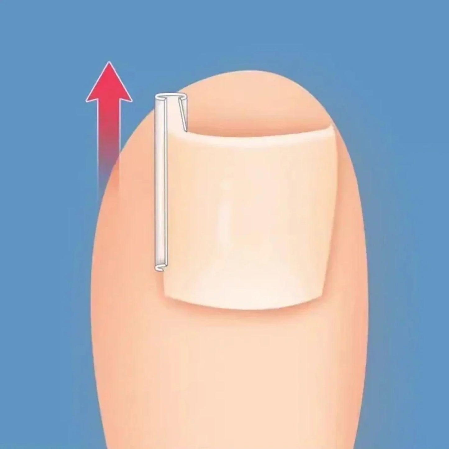 50Pcs Ingrown Toenail Correction Tool Ingrown Toe Nail Treatment Elastic Patch Sticker Straightening Clip Brace Pedicure Tool