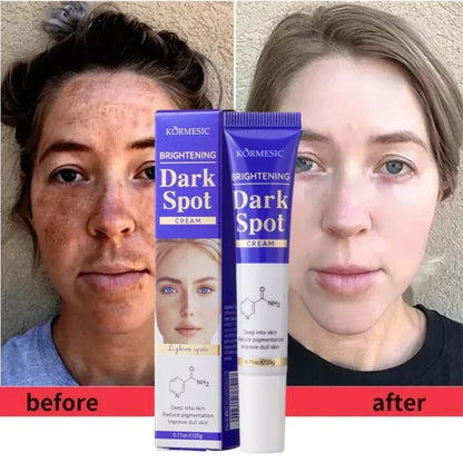 Dark Spots Removal Cream Facial Whitening Freckle Acne Mark Pigmentation Removal Melanin Skin Correction Brighten Care Products